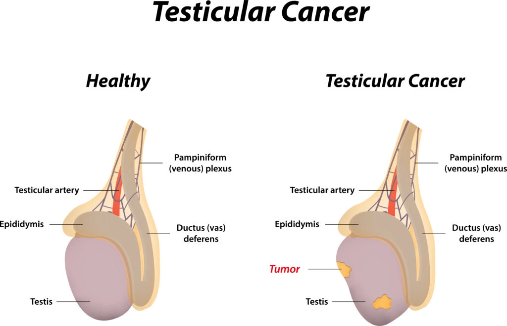 Ung thư tinh hoàn (Testicular cancer)