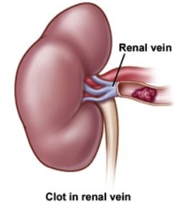 Huyết khối tĩnh mạch thận (Renal vein thrombosis)