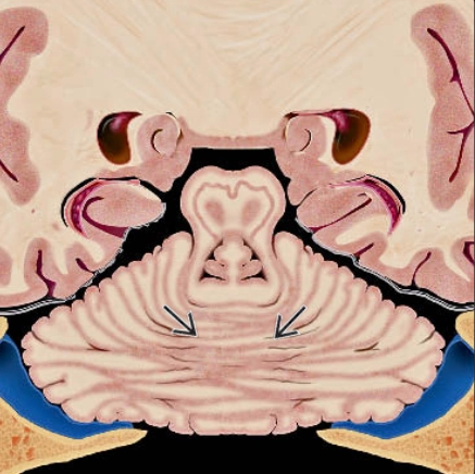 TẬT DÍNH TRÁM NÃO (RHOMBENCEPHALOSYNAPSIS)