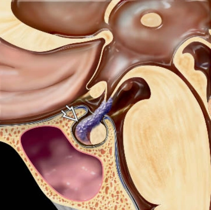 Viêm tuyến yên lympho bào (Lymphocytic Hypophysitis)