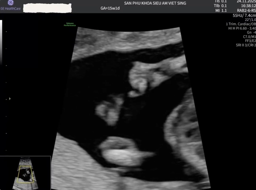 Sứt môi hở hàm ếch ở thai nhi (Cleft lip and palate)