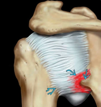 Tổn thương Bennett ở vai (Bennett lesion of the shoulder)