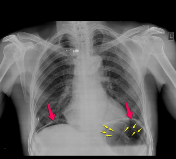 Dấu hiệu Rigler/Dấu hiệu thành đôi (double-wall sign)