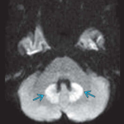 Độc tính thần kinh trung ương do Metronidazole (Metronidazole central nervous system toxicity)