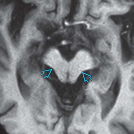 Liệt trên nhân tiến triển (PSP - Progressive Supranuclear Palsy)