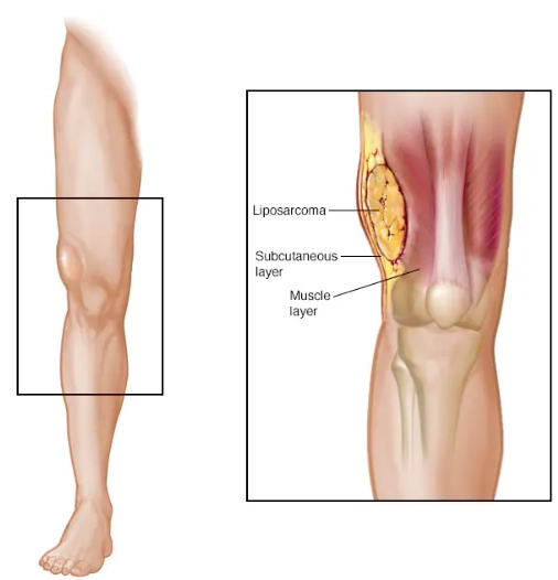 Sarcoma mỡ (Liposarcoma)