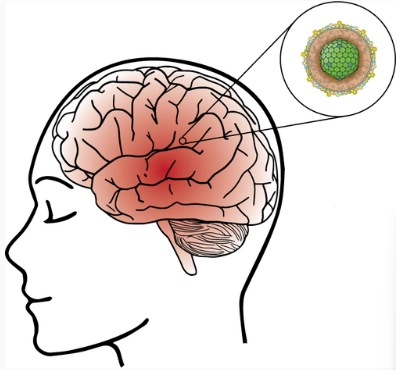 Viêm não do Virus (Viral Encephalitides)