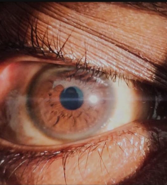 Bệnh Wilson- Biểu hiện ở não bộ (Wilson Disease)