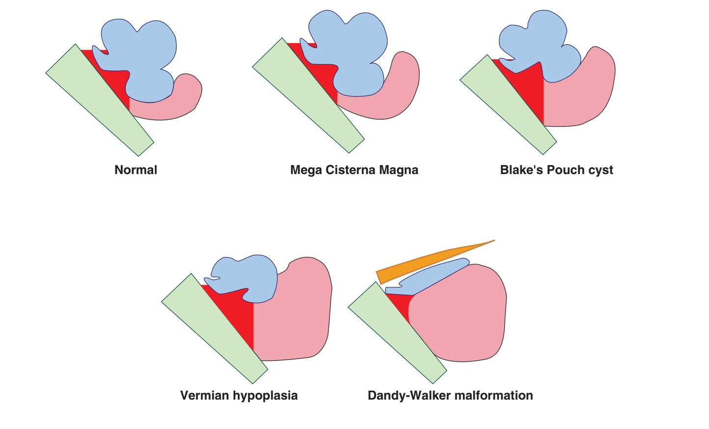Tổng quan bất thường hố sau (Posterior Fossa Anomalies)