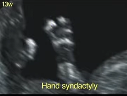 Tật dính ngón ở thai (Syndactyly)