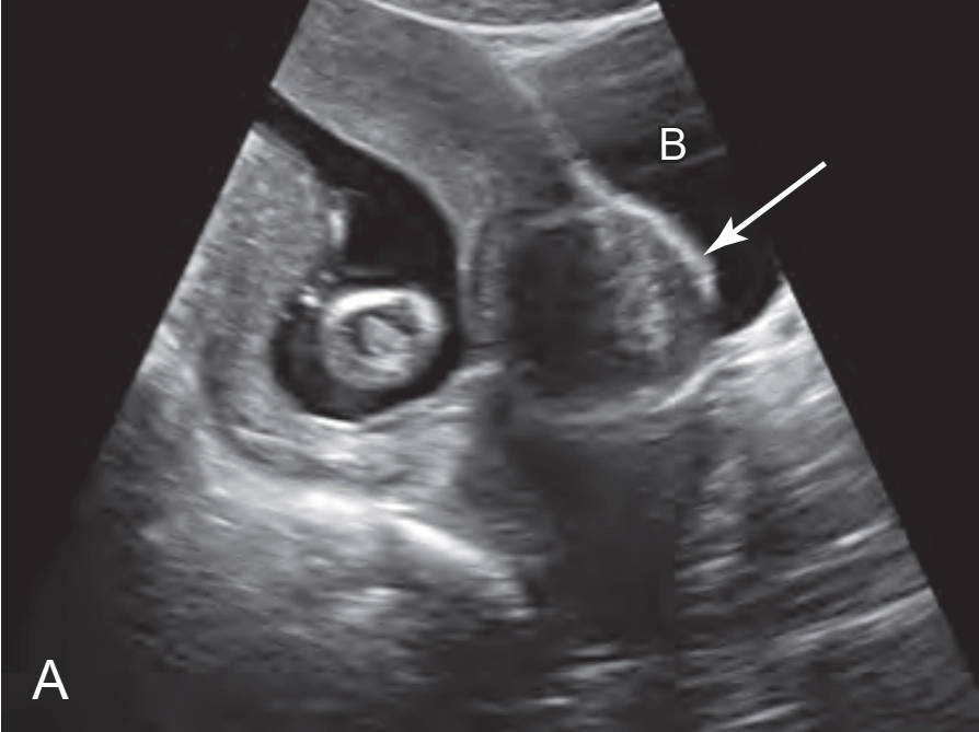 Nhân xơ trong thai kỳ (Fibroids)