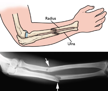 Gãy xương cẳng tay (Forearm Fractures)