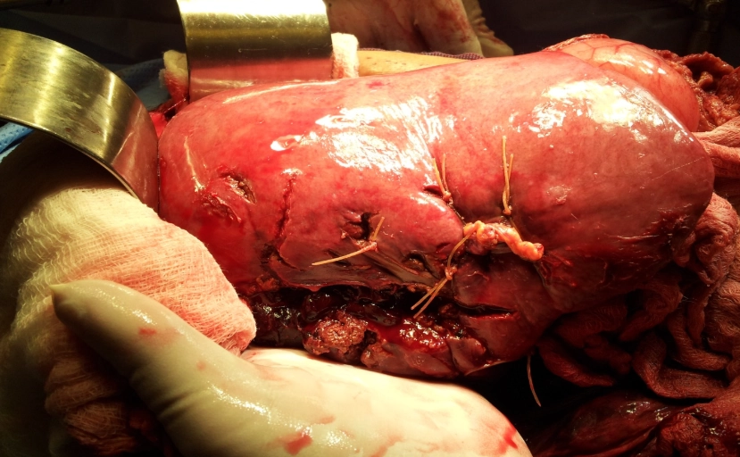 Chấn thương gan (Liver trauma)