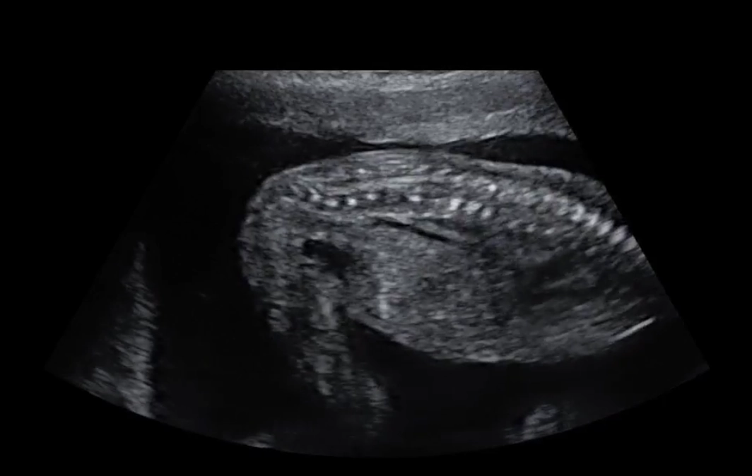 Loạn sản xương đòn - sọ ở thai (Cleidocranial Dysplasia - CCD)