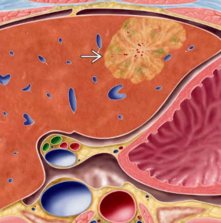 Tăng sản nốt khu trú (Focal Nodular Hyperplasia - FNH)