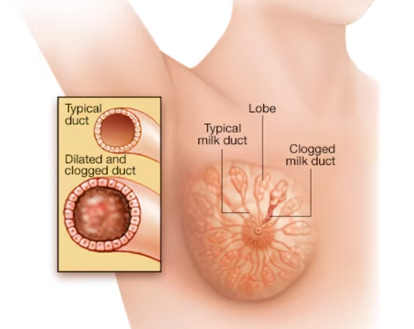 Giãn ống tuyến vú (Mammary duct ectasia)
