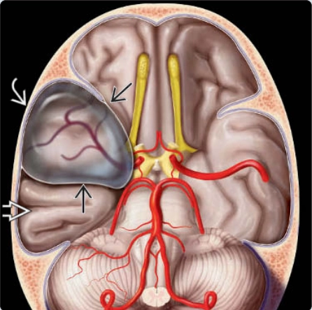 Nang màng nhện thai nhi (Arachnoid Cyst)