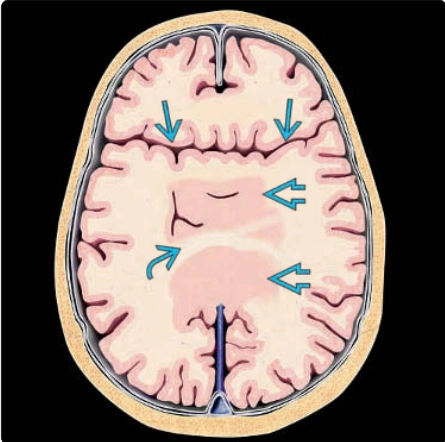 Não trước không phân chia thể dính não giữa (Syntelencephaly)