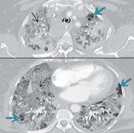 Hội chứng Goodpasture (Goodpasture Syndrome)