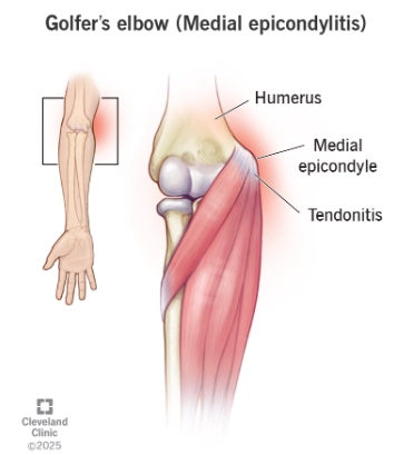 Tổn thương gân gập-sấp chung (Common Flexor-Pronator Tendon Injury)