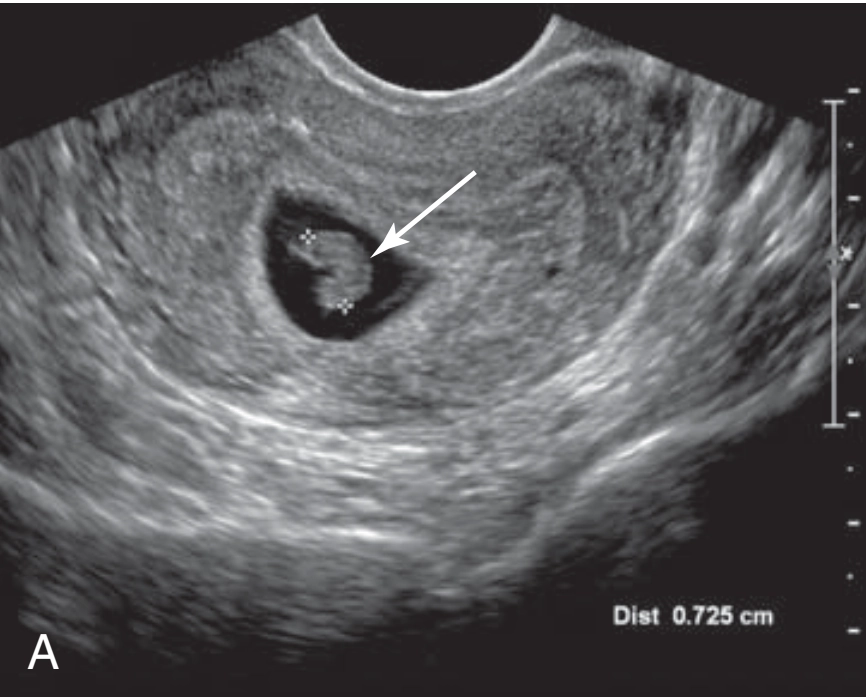 Chẩn đoán xác định sẩy thai