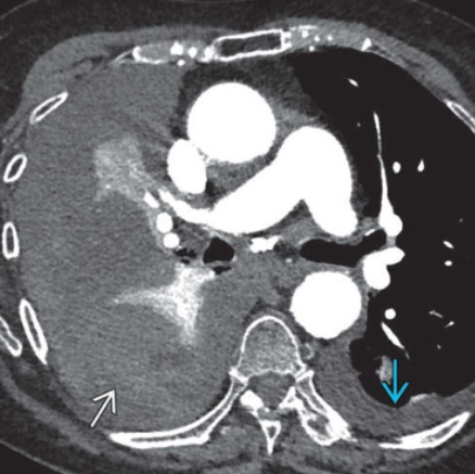 Tràn máu màng phổi do chấn thương (Traumatic Hemothorax)