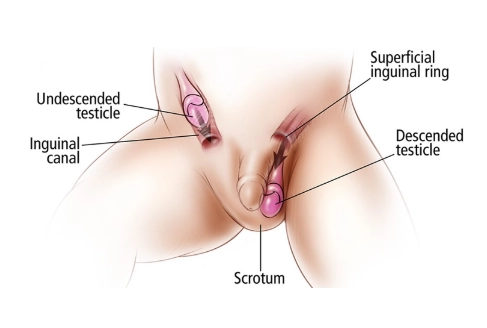 Tinh hoàn ẩn (Cryptorchidism)