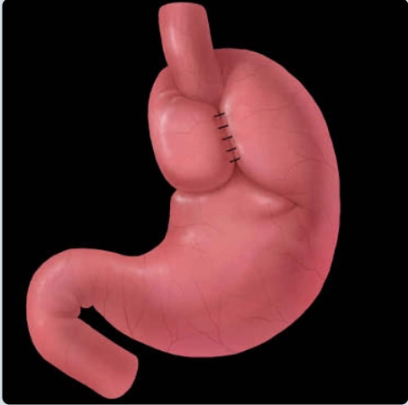 Biến chứng của phẫu thuật tạo nếp đáy vị (Fundoplication Complications)