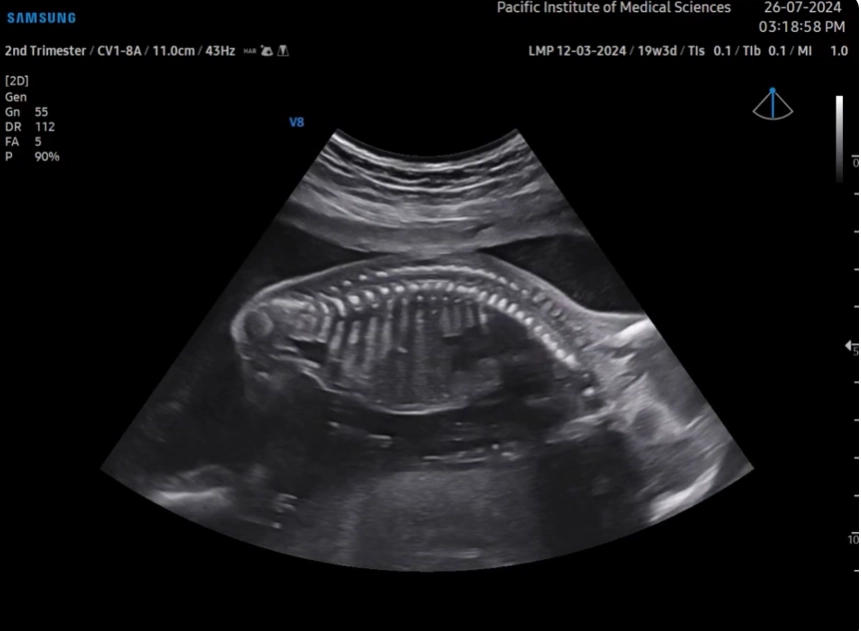 Loạn sản sụn dạng chấm (Chondrodysplasia Punctata)