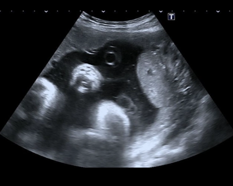 Nhau phụ (Succenturiate Lobe)