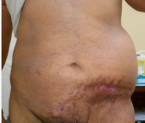 Thoát vị thành bụng do chấn thương (Traumatic Abdominal Wall Hernia)