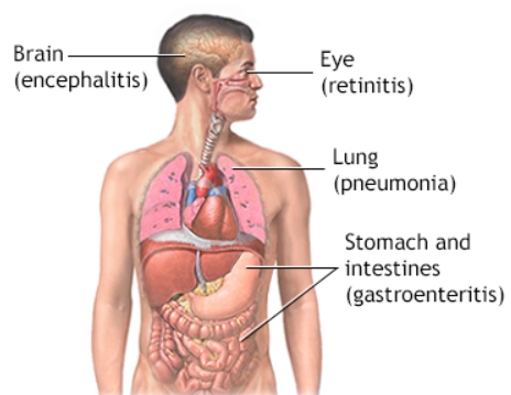 Viêm phổi do Cytomegalovirus ( Cytomegalovirus pulmonary infection  - CMV)