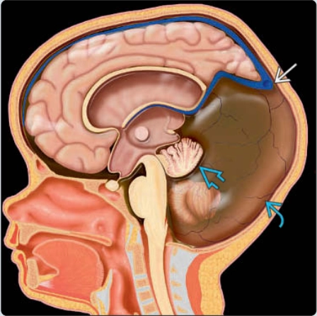 Dị dạng Dandy-Walker ở thai (Classic Dandy-Walker malformation)