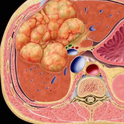 U tuyến nang đường mật (Biliary Cystadenoma)