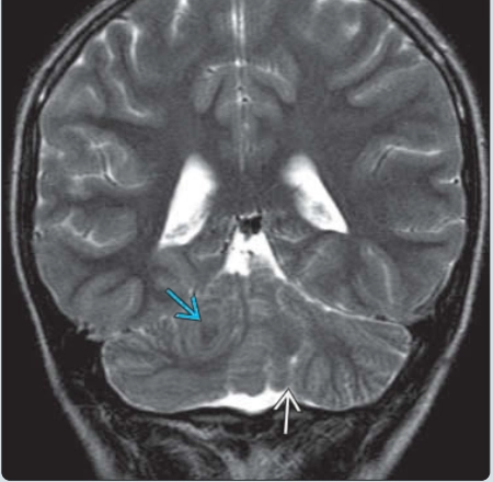 LOẠN SẢN TIỂU NÃO KHÔNG PHÂN LOẠI (UNCLASSIFIED CEREBELLAR DYSPLASIA)
