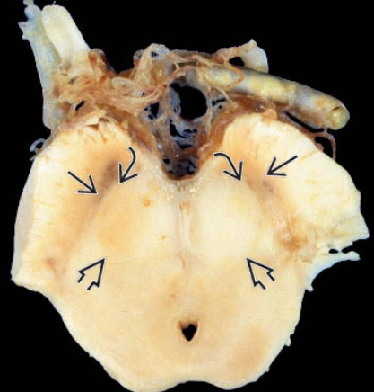 Bệnh Parkinson (Parkinson Disease)