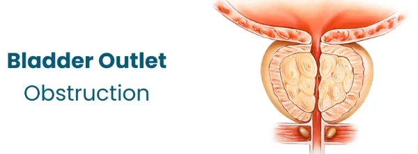 Tắc nghẽn đường ra của bàng quang (Bladder Outlet Obstruction - BOO)