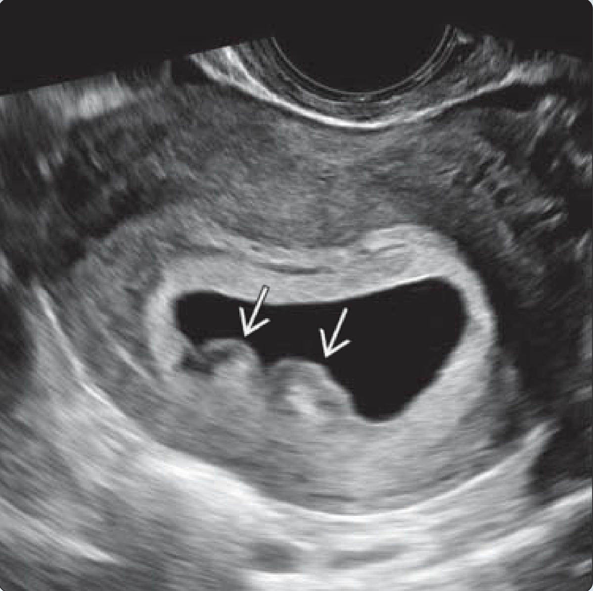 Khối phồng màng đệm (Chorionic Bump)