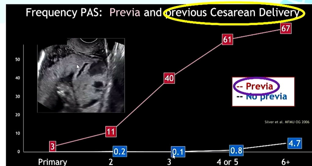 Nhau cài răng lược (Placenta Accreta Spectrum - PAS)