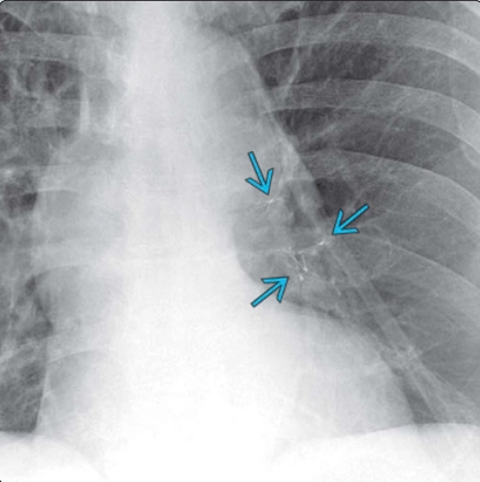 Phẫu thuật giảm thể tích phổi (LUNG VOLUME REDUCTION SURGERY - LVRS)
