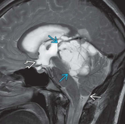 U nhu mô tuyến tùng biệt hóa trung gian (Pineal Parenchymal Tumors of Intermediate Differentiation - PPTID)