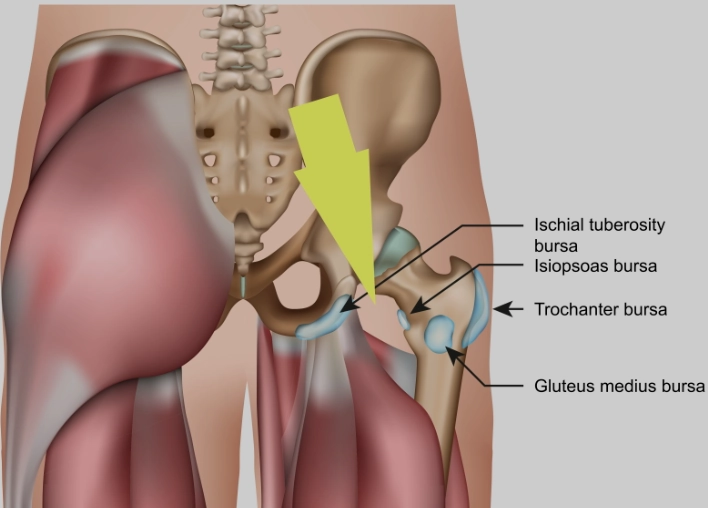 Hội chứng kẹt (chẹn) ụ ngồi-xương đùi (Ischiofemoral impingement)