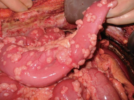 U trung biểu mô phúc mạc ác tính (Malignant Peritoneal Mesothelioma)