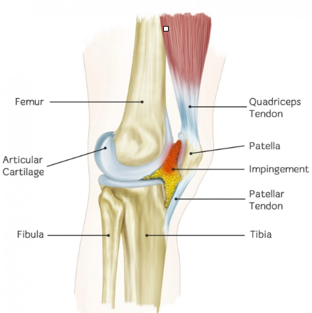Hội chứng chèn ép túi mỡ trước đùi (Prefemoral fat pad impingement syndrome)