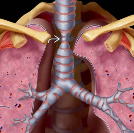Hẹp khí quản (Tracheal Stenosis)