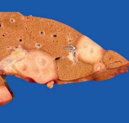 U nội mô mạch máu dạng biểu mô ở gan (Epithelioid Hemangioendothelioma - EHE)