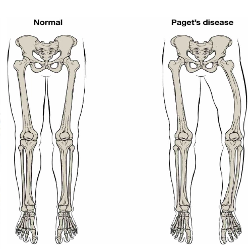 Bệnh Paget ở xương (Paget disease)