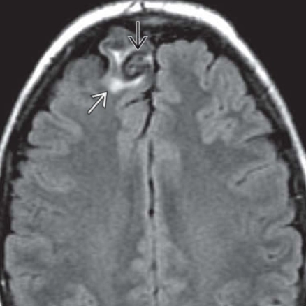 U mạch màng não (Meningioangiomatosis)