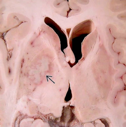 Viêm não do Toxoplasma (Toxoplasmosis Encephalitis)