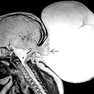 Dị dạng Chiari III ở thai nhi (Chiari III malformation)